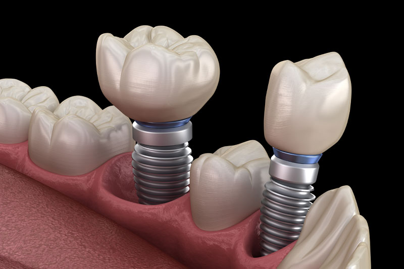 How Dental Implants Look In Your Mouth
