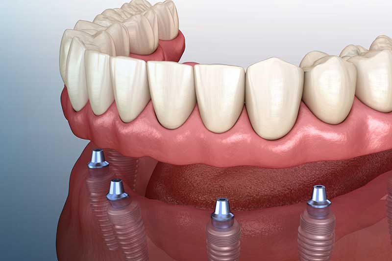 a model of implant supported dentures