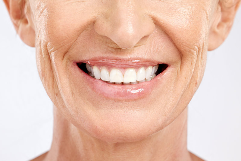 An image of an older woman smiling with porcelain veneers.