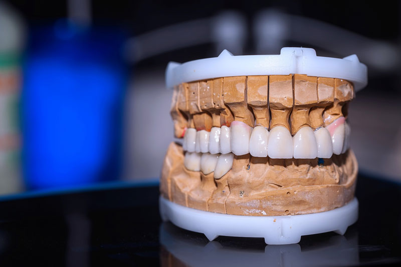 high quality image of a dental full mouth prosthesis on a black table with a blurred background