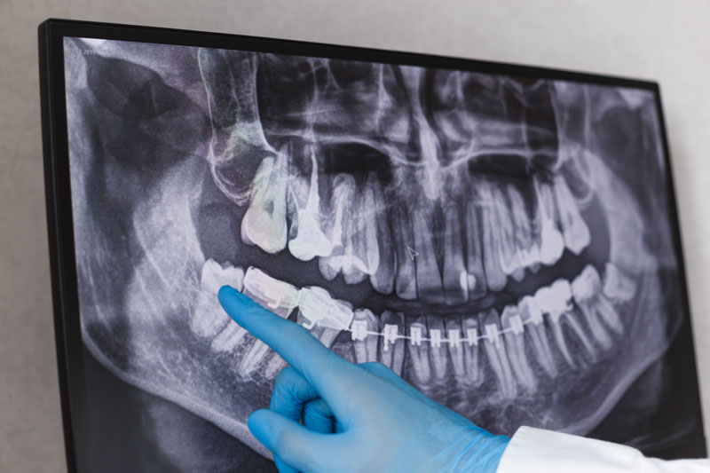 photo of a doctor pointing to a wisdom tooth on a xray sheet