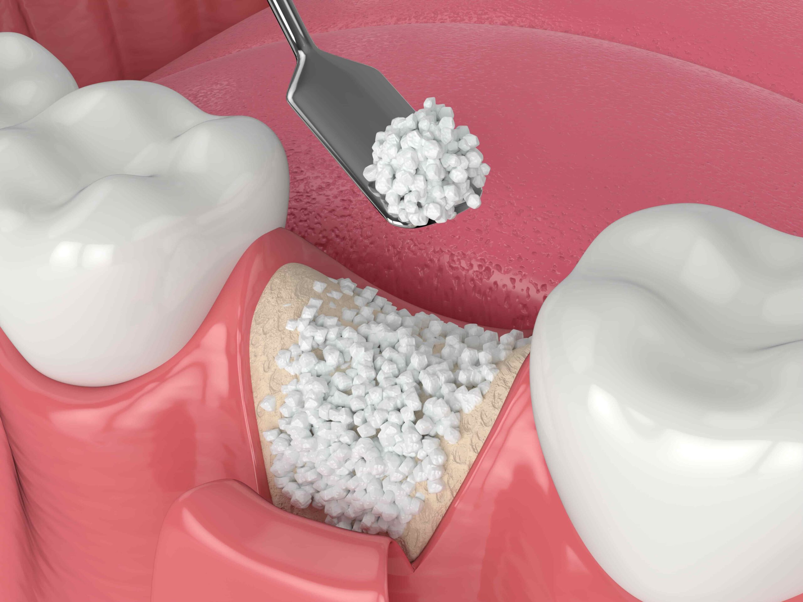Bone Grafting banner Image
