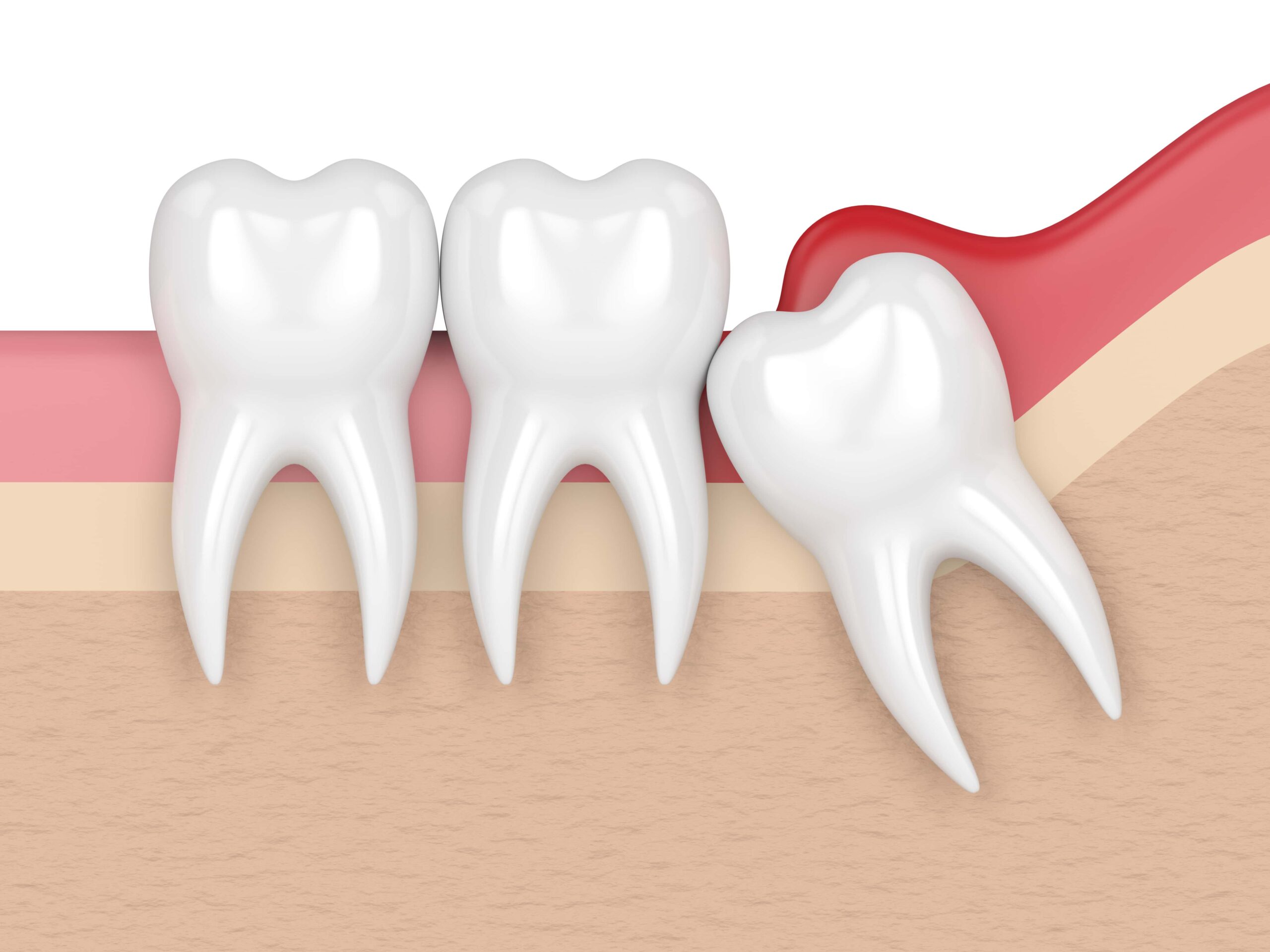 Impacted Tooth banner Image