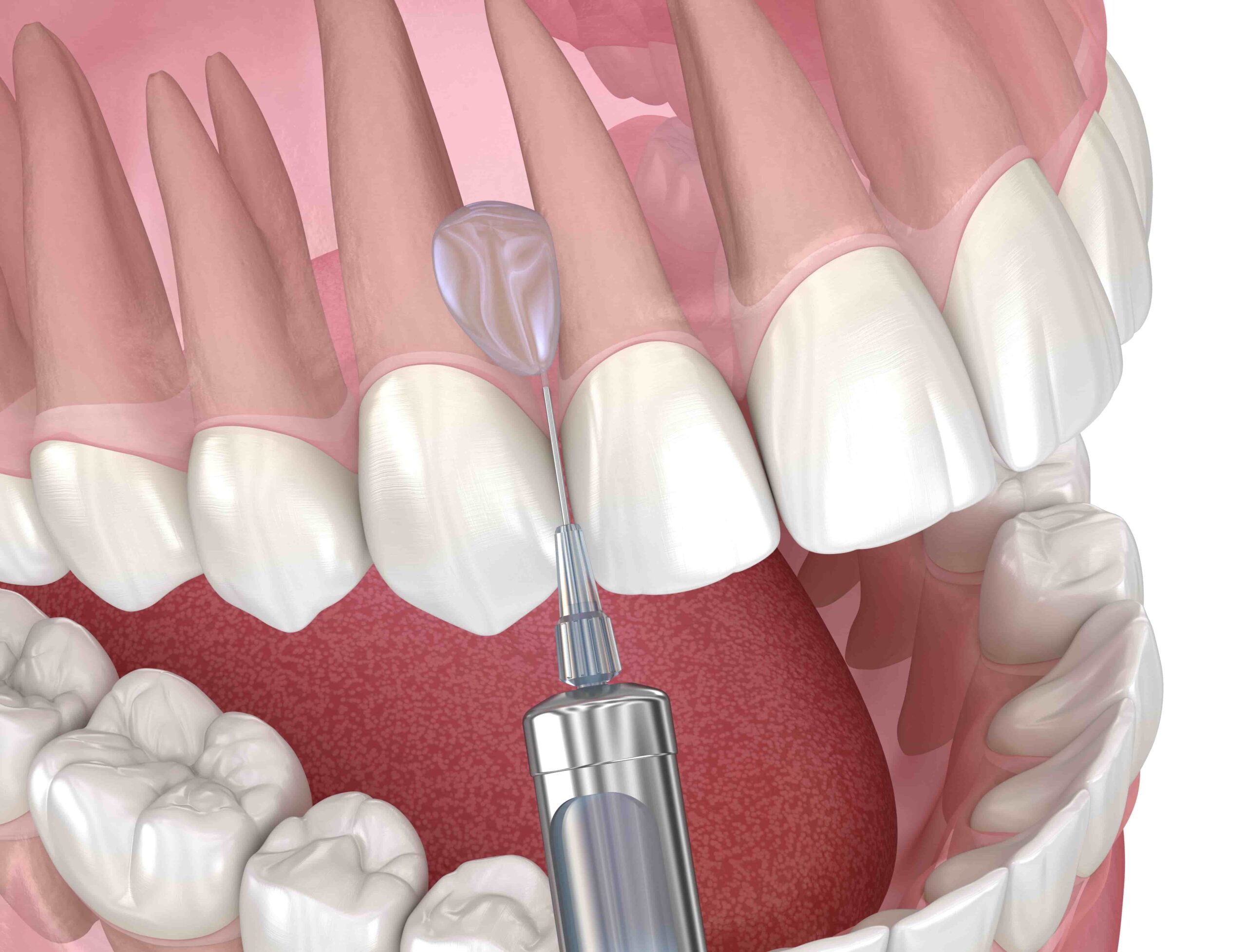 Local Anesthesia Banner Image