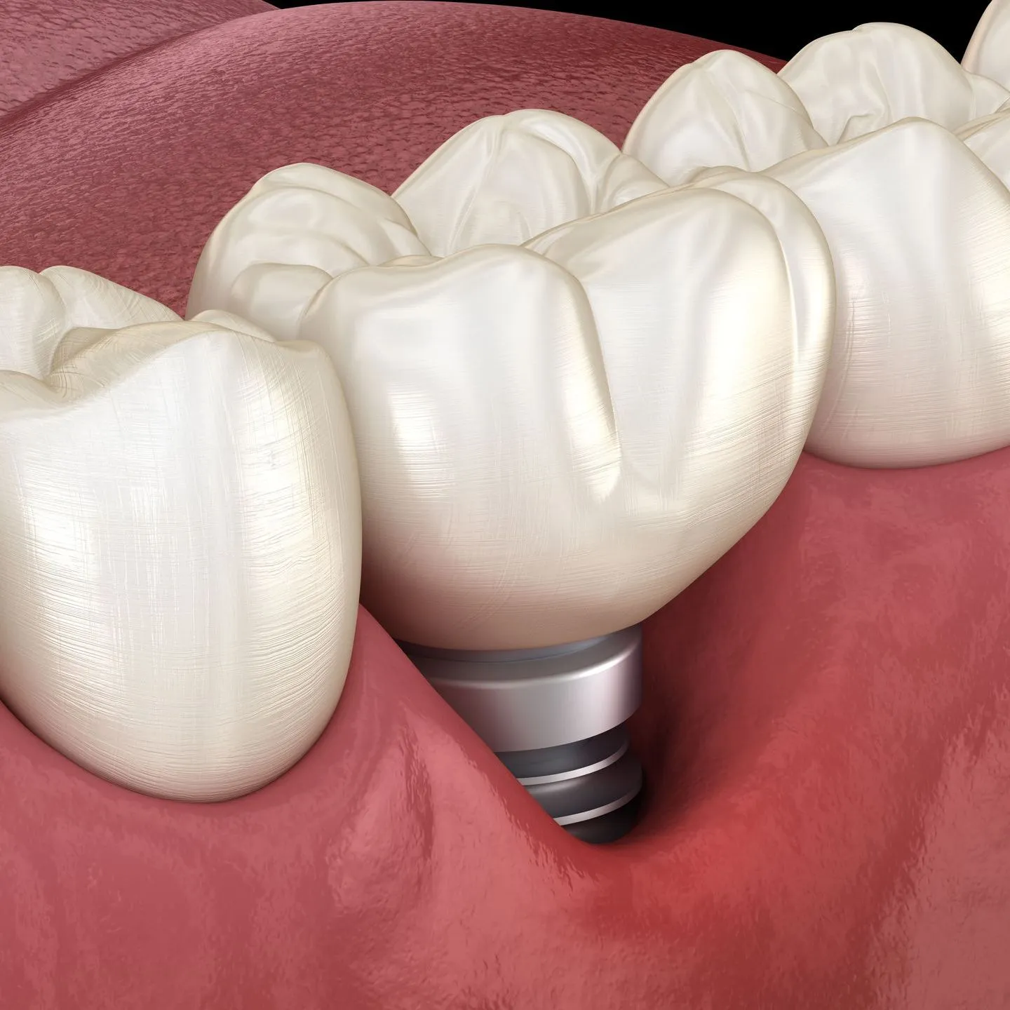 failing dental implants