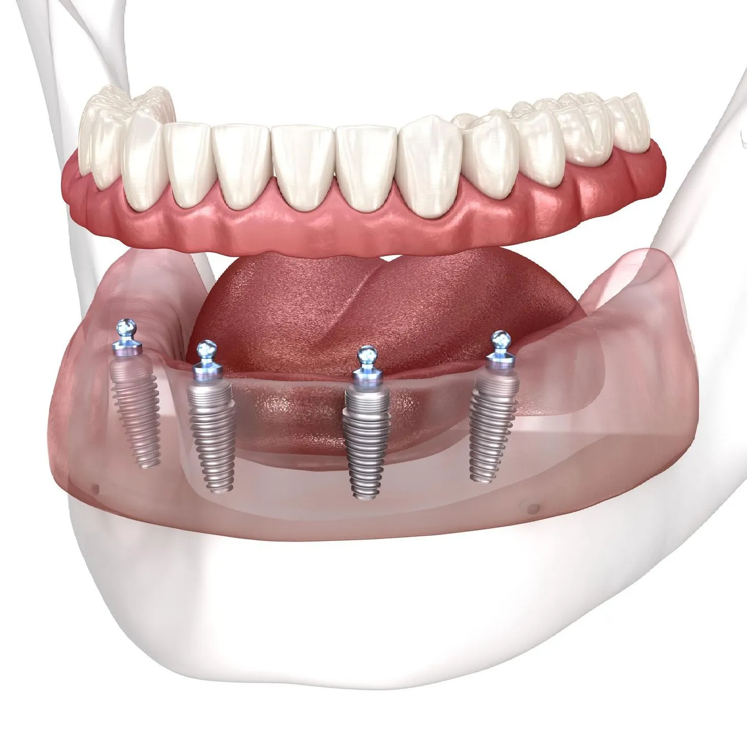 Implant-Retained Dentures
