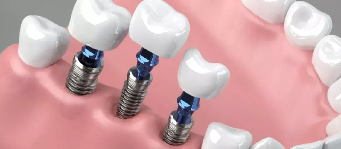 Implants Replace Many Teeth