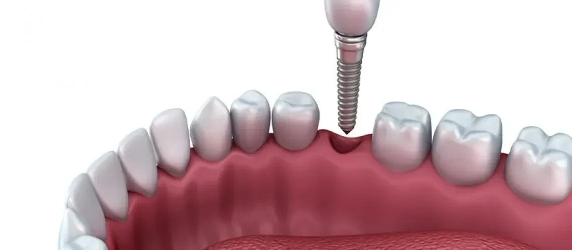 Dental Implant Components Close-Up