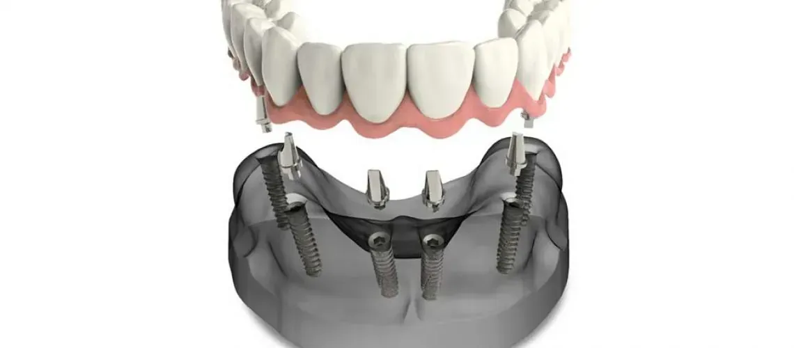 Implant Supported Dentures Blog Img