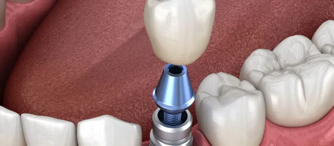 Cleaning Dental Implants