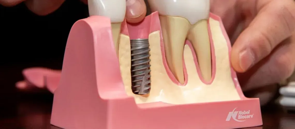 Dental Implants Model