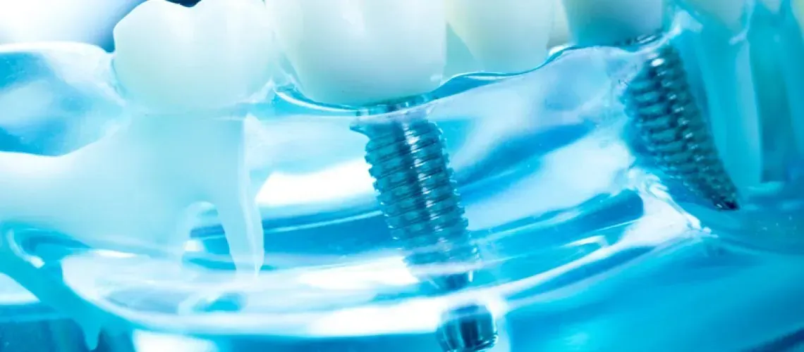 Second Image of Dental Implants