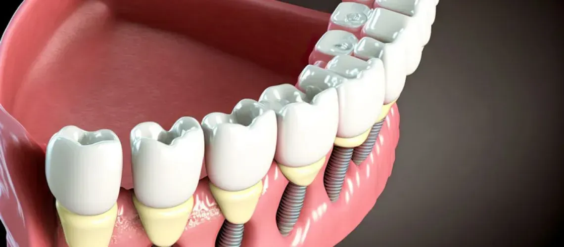 Full Mouth Dental Implants