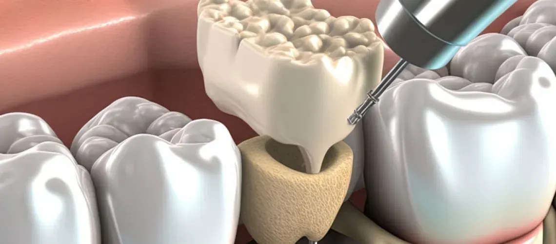 Bone Grafting Procedure