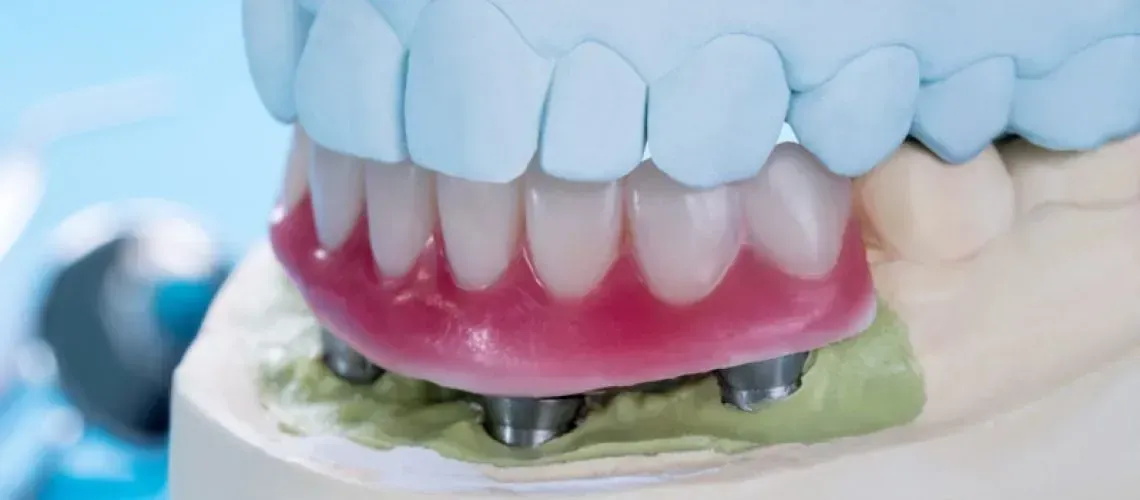 Stable Implant-Supported Smile