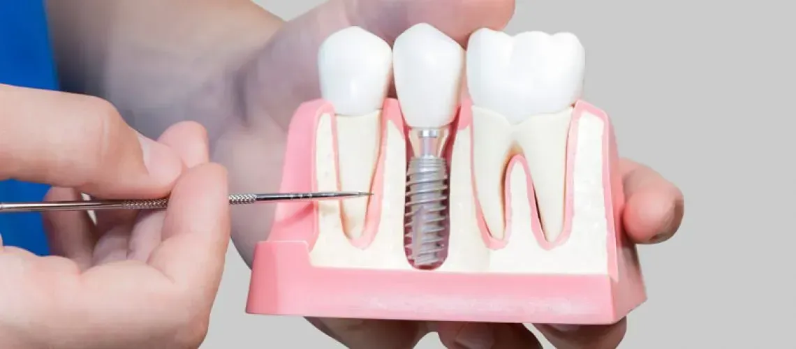 Benefits of Dental Implants