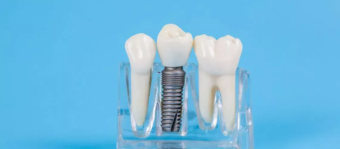 Dental Implant Step-By-Step