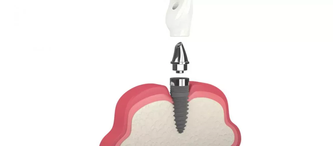 Implant Benefits Summary