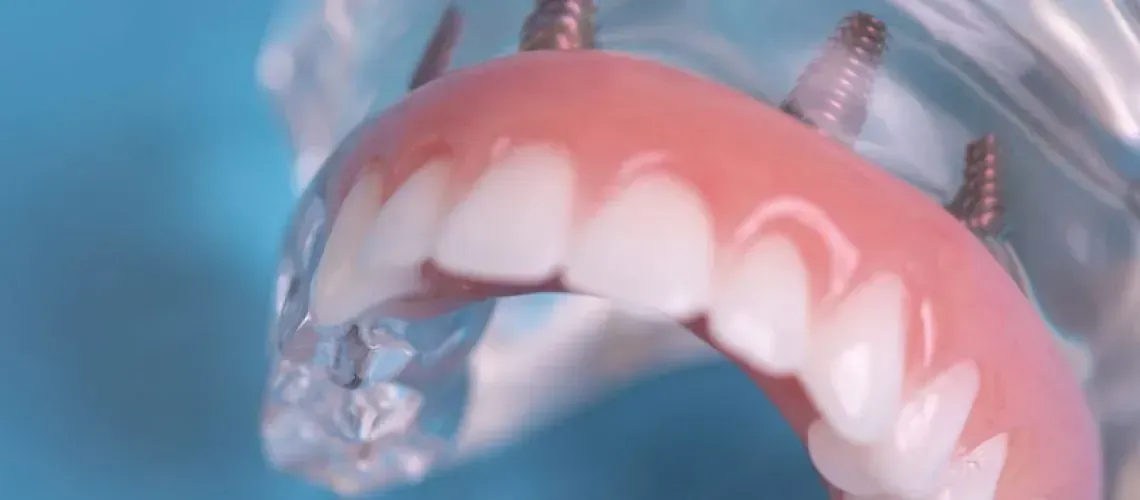 Full Arch Dentures