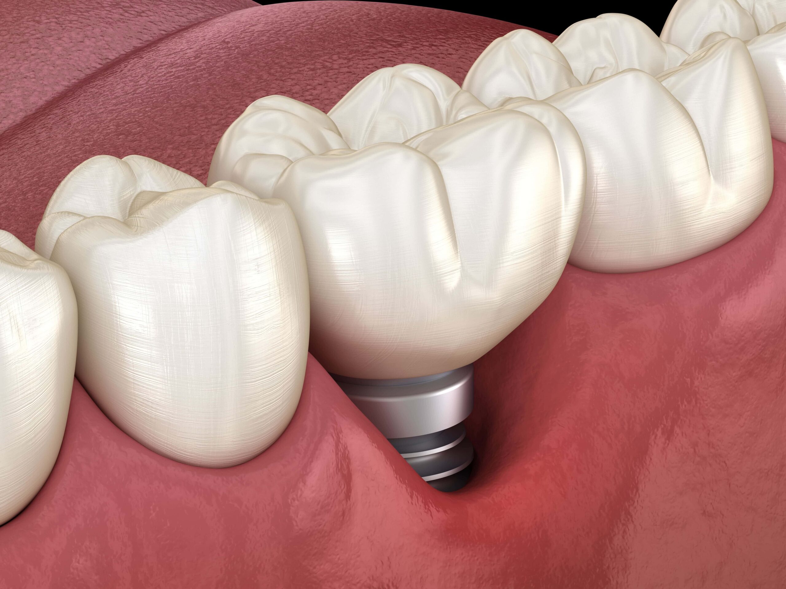Failing Dental Implants