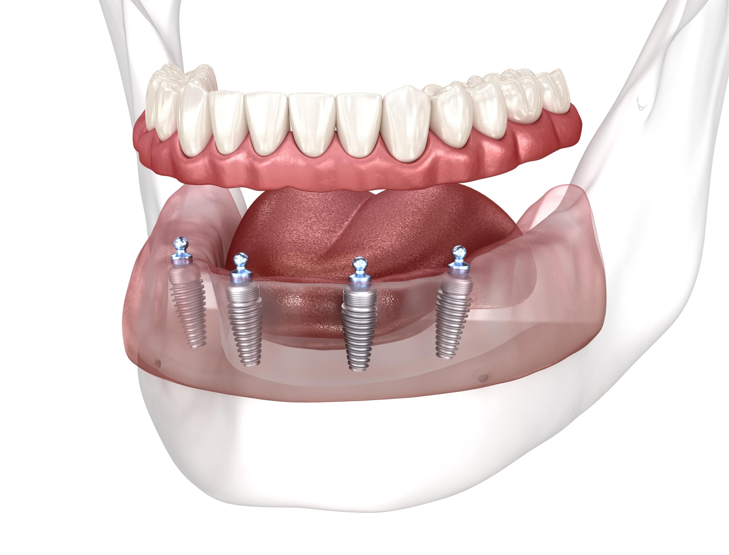 Implant-Retained Dentures