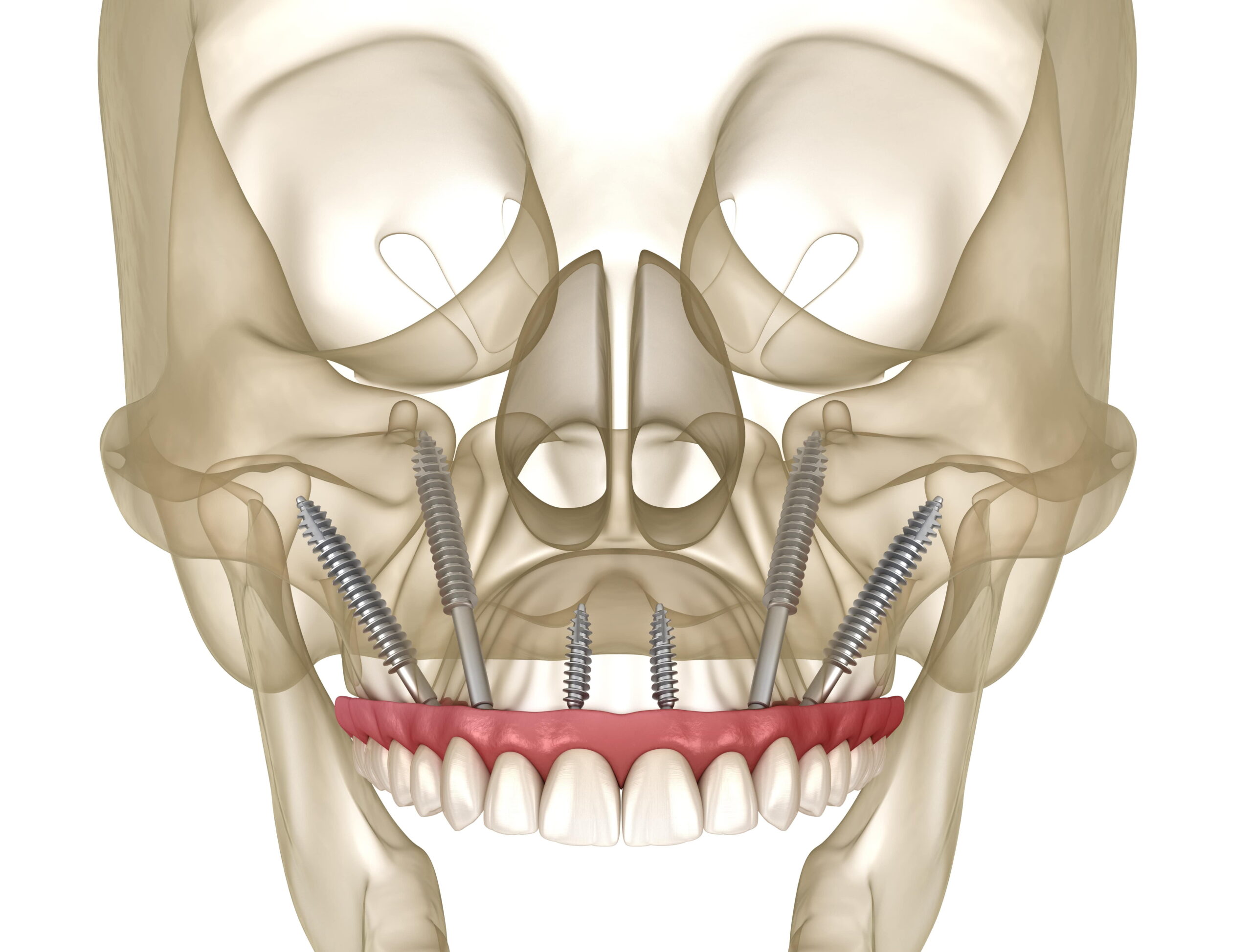 Zygomatic Dental Implants