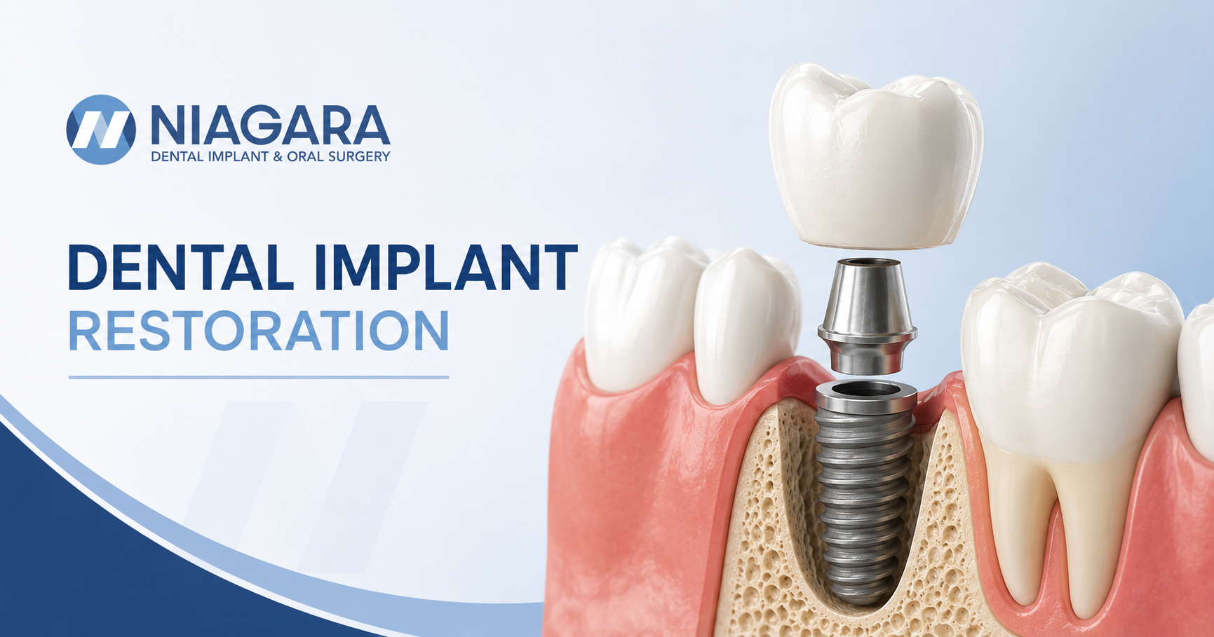Dental implant restoration showing implant crown, abutment, and implant post at Niagara Dental Implant & Oral Surgery
