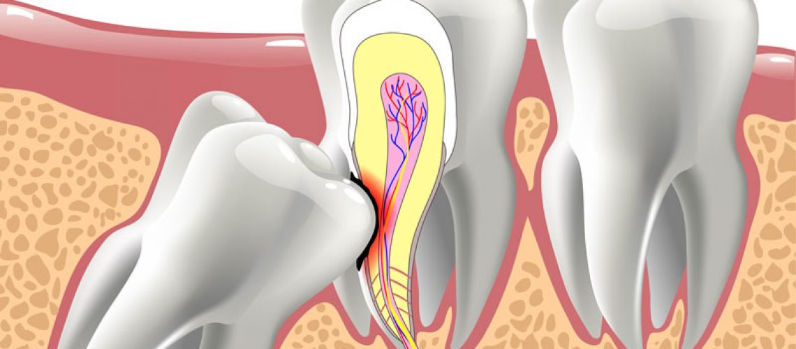 A 2d image showing a wisdom tooth causing discomfort.