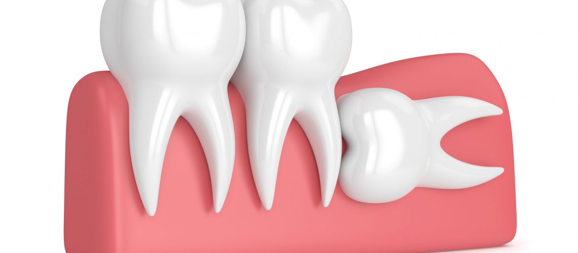 3d render of teeth with wisdom horizontal impaction over white background. Concept of different types of wisdom teeth impactions.
