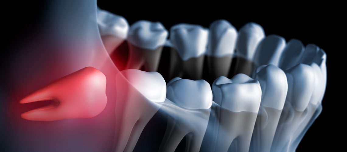 a 3D image of an impacted wisdom tooth that needs removed.