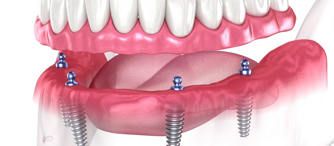 Dental prosthesis based on 4 implants. Dental 3D illustration.