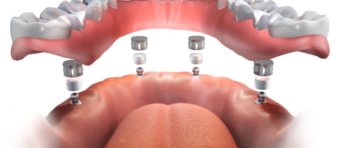 implant supported dentures model showing behind the jawline.
