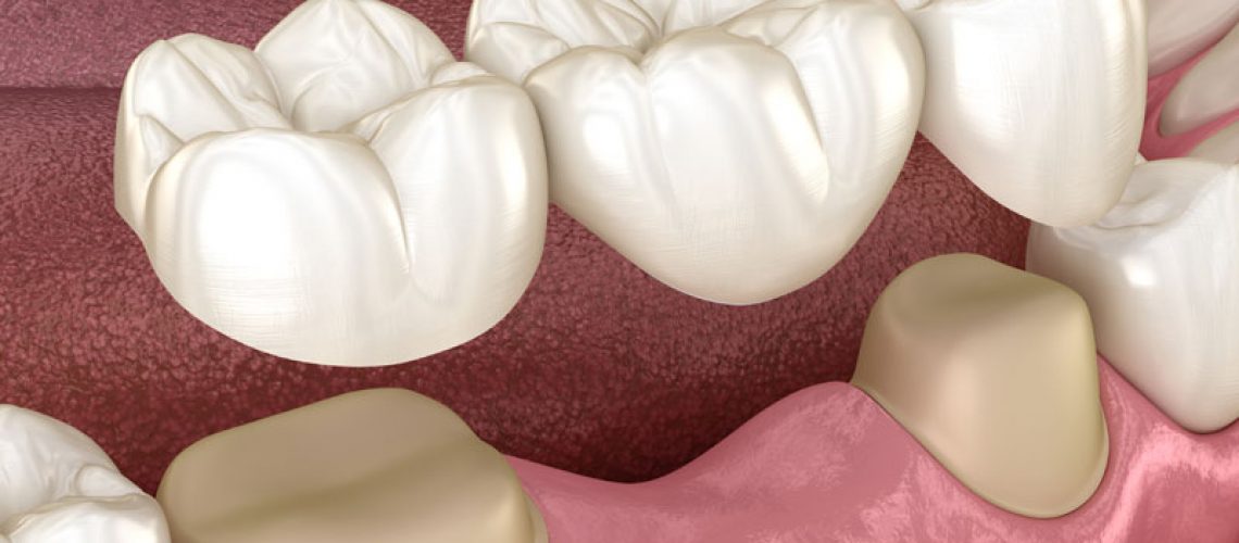 How A Dental Implant Fits In Your Mouth