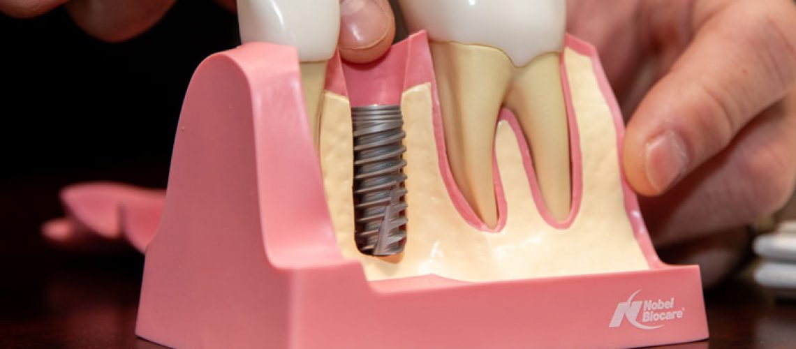 Dental Implants In Your Bone, Model