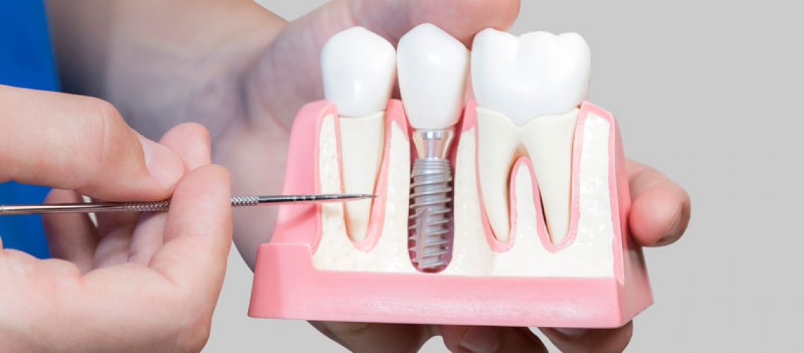a picture of an oral surgeon showing patients a dental implant model so he can explain what the benefits of dental implants are. the oral surgeon is pointing to the dental implant post in the picture.