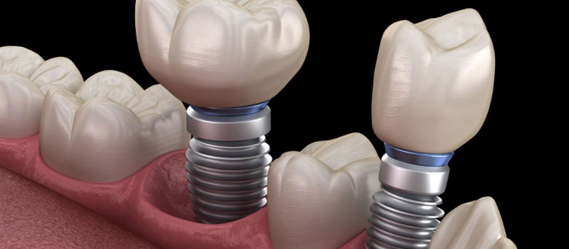 How Dental Implants Look In Your Mouth