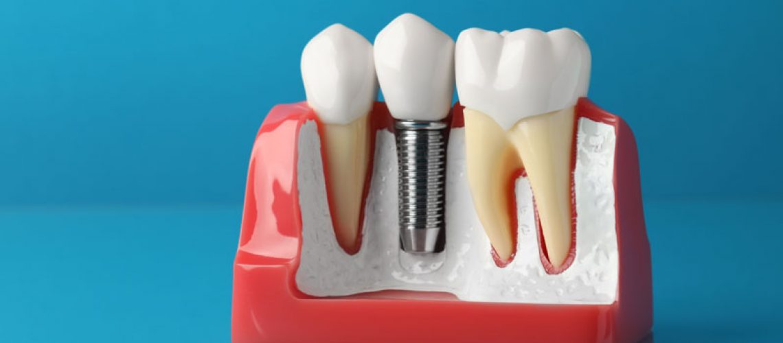 single dental implant model, with a blue background