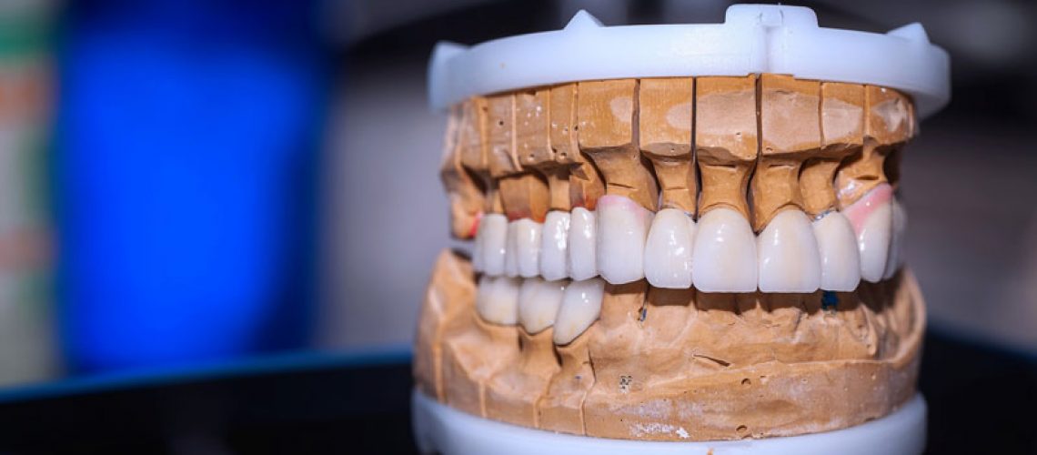high quality image of a dental full mouth prosthesis on a black table with a blurred background