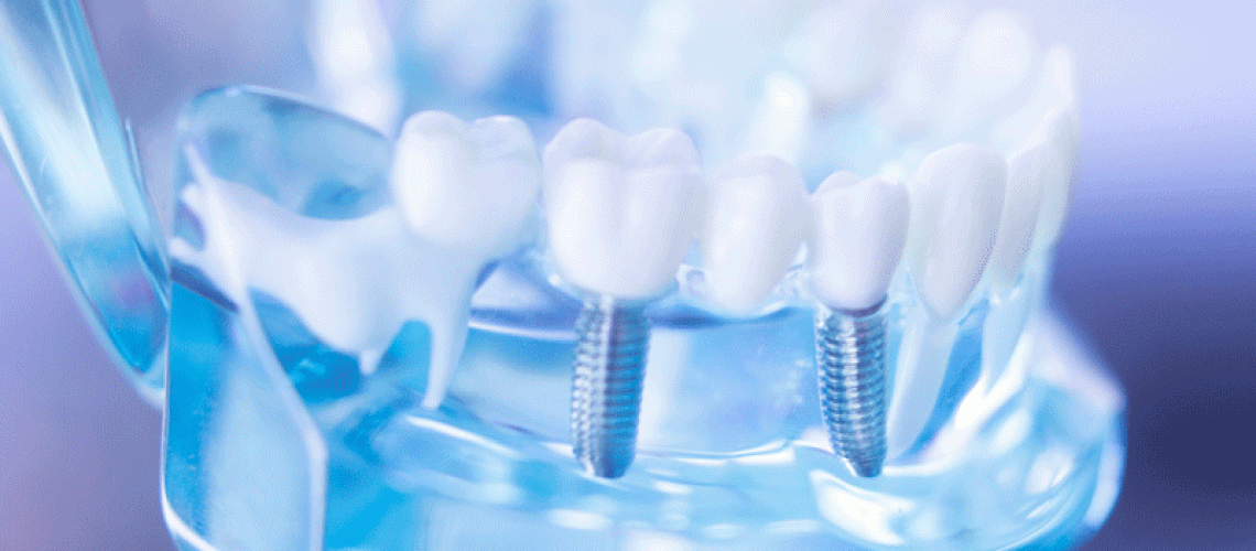 Dentist clear jaw model, dental tooth implant