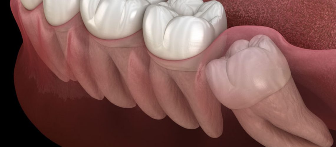digital model of an impacted wisdom tooth in a jawline.
