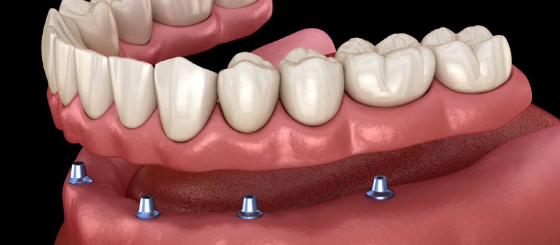an implant supported denture model that shows how, in an implant supported denture procedure, dental implants are used to secure the denture in place in the patient's mouth.