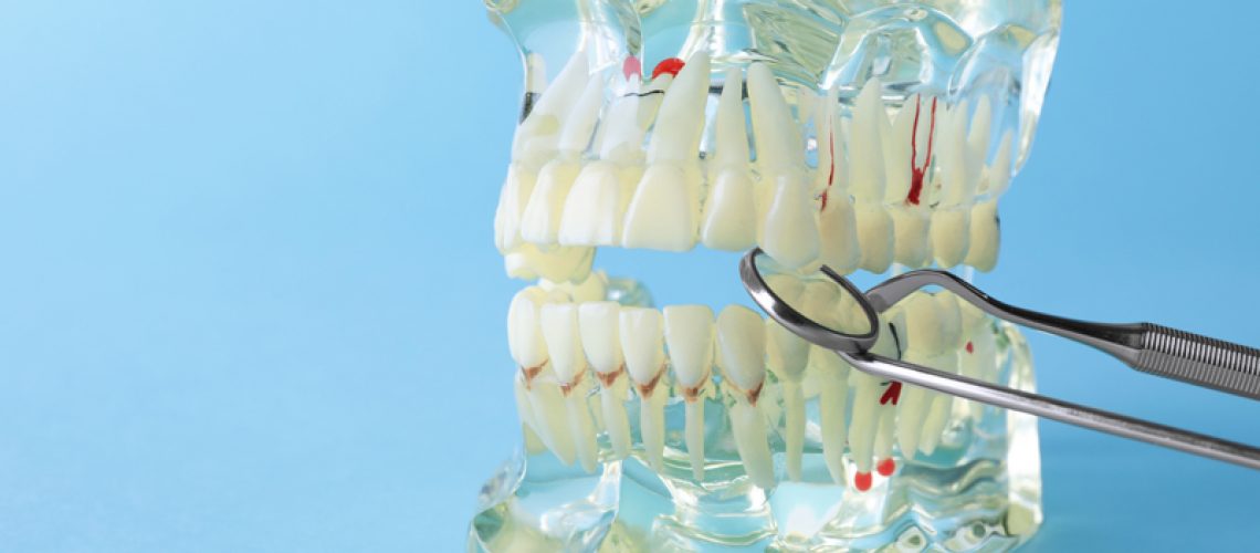 3d image of a dental implant bridge and a prosthesis jaw with a blue backdrop.