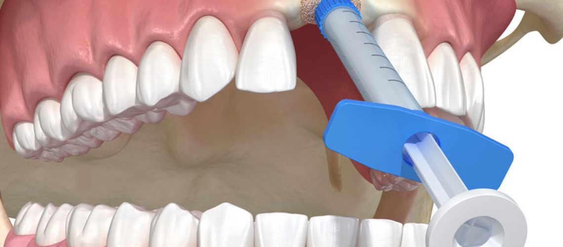 socket preservation and bone grafting to prepare for a dental implant.