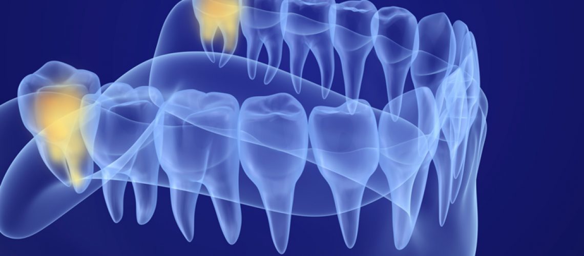 a 3D image of a wisdom tooth extraction.