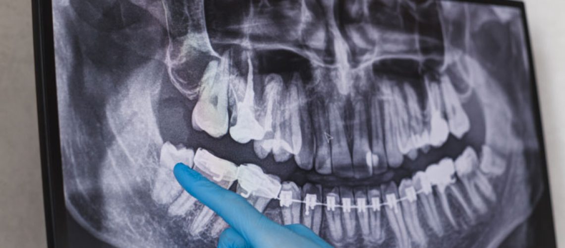 photo of a doctor pointing to a wisdom tooth on a xray sheet